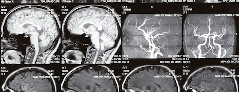 Adenom hypofýzy